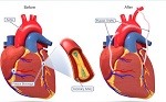 cirugia del baipás coronario