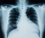 ecografía pulmonar