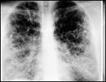pulmones con  fibrosis pulmonar