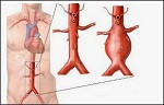 arteritis de Takayuasu (2)
