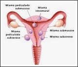 miomas uterinos