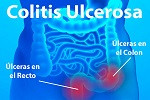 Colitis-Ulcerosa