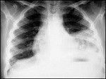 mucormicosis pulmonar