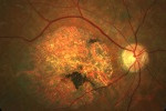 retinopatía de Stargardt