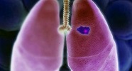 cáncer-de-pulmón-no-microcítico