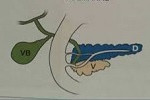 agenesia dorsal del páncreas