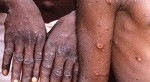 viruela del mono - mpox