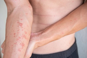 Estos son los 4 consejos básicos para afrontar la dermatitis atópica de cara al otoño-invierno