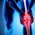 osteoartrosis rodilla